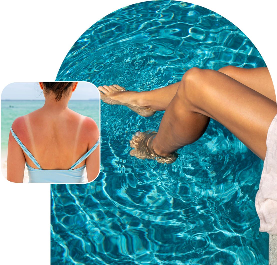 Person with sunburned shoulders in a blue swimsuit inset over legs in a pool.